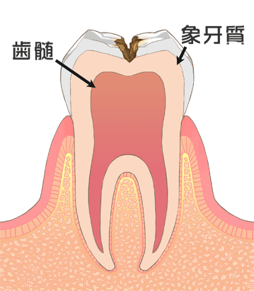C2：感染歯質が表層のエナメル質を超え、2層目の象牙質内に入り込んだ状態