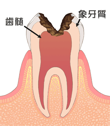 C3：感染歯質が2層目の象牙質深部または髄腔（神経の中）内まで達した状態