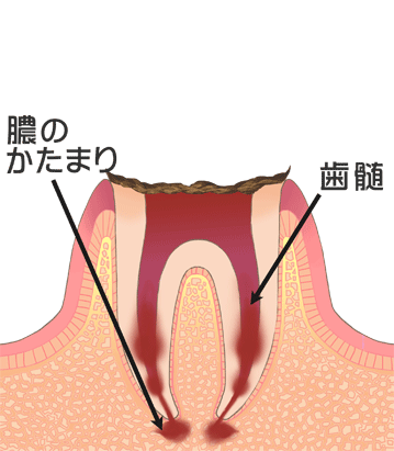 C4：歯冠部（歯の見える部分）がほとんどなくなり、歯の根だけ残った状態