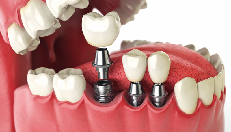 インプラント3本の場合